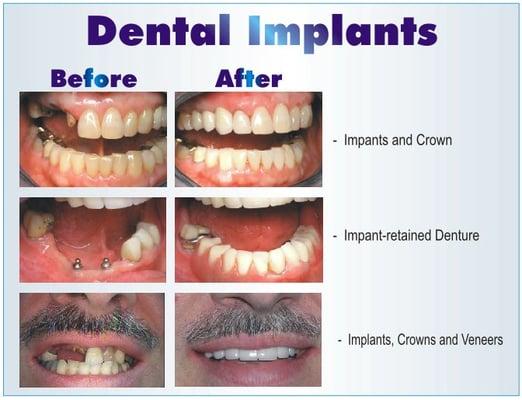 Dental Implants can change your Life!