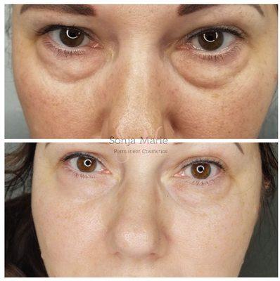 Healed results from Fibroblasting Skin Tightening