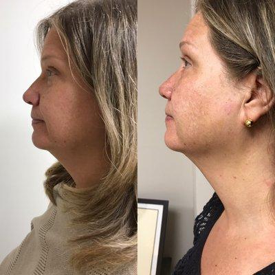 After 3 treatments, her chin and neck have tightened up and have a more youthful and radiant appearance.