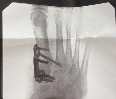 X-ray of right bunion surgery