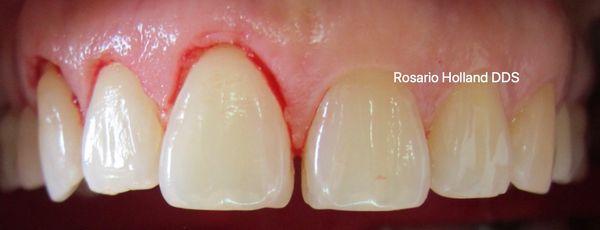 Crown Lengthening. Sometimes you hide bigger and beautiful teeth!