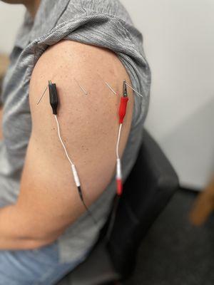 Trigger point dry needling with electric stimulation