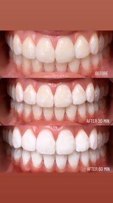 LED teeth whitening