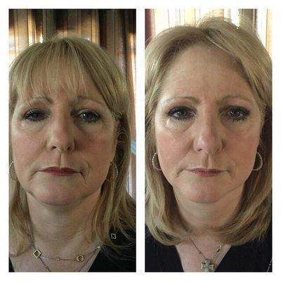 Facial rejuvenation after 1 treatment!!!