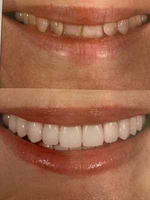 Before and after cosmetic dentistry example