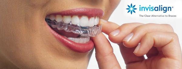 Invisalign braces available at our office