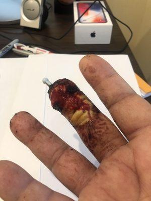 Finger after operation