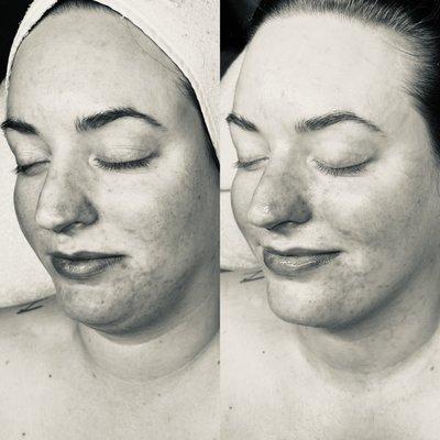 A black and white to see the improvement of pigmentation in her breakouts!