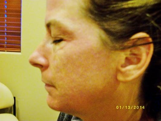 After 3 treatments of Microdermabrasions and Microneedling.