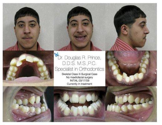 Skeletal Class III - Adult 'Underbite' Before Braces ***NO SURGERY***