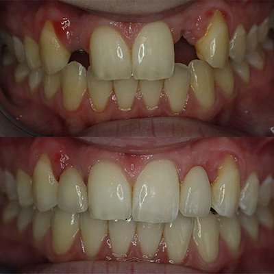 Dental Implants Midtown Manhattan | Before After