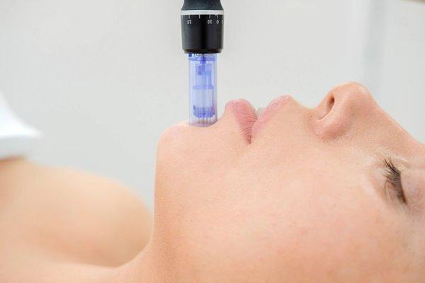 Microneedling