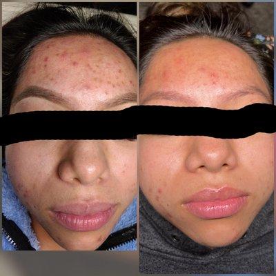 Chemical peel series of 3. Pictures are 6 weeks apart