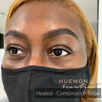 Healed combination brow