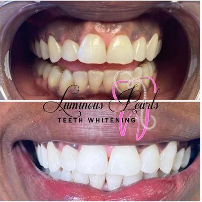 These amazing results are from our 60 Minute 24K Teeth Whitening session. Your Smile says a lot, let luminous Pearls help you speak volumes!