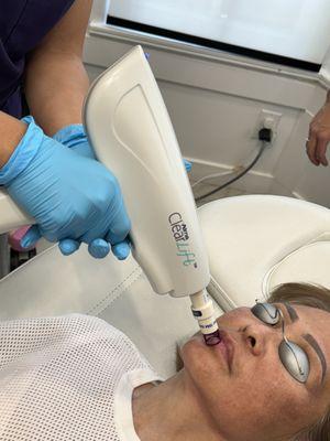 Alma ClearLift laser toning for lip plumping- a natural alternative to fillers!