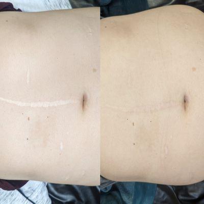 Scar Revision: Before and After (healed, one session)