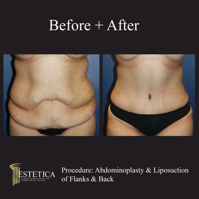 Extra skin taken off and those stomach muscles tightened! This is the patient before and 3 months post op.