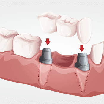 Fixed Bridge
 A bridge consists of both a false tooth, called a pontic and the anchors that support the pontic.