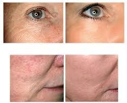 Chemical Peel with Microdermabrasion