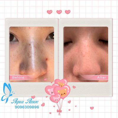 Dark spots treatment