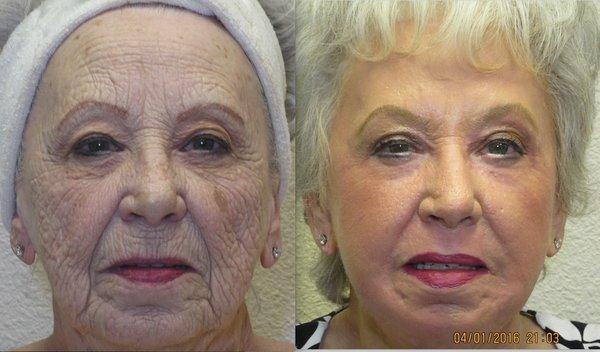 Renuvion non-surgical face lift