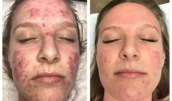 Before & After Rhonda Allison 90 day Acne series