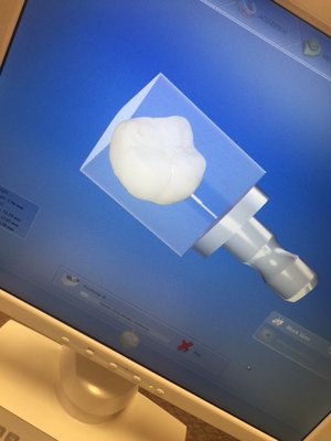 CEREC Technology Design Phase for a Dental Crown