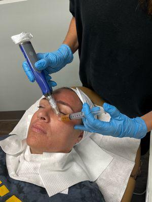 SkinPen Microneedling with PRP.