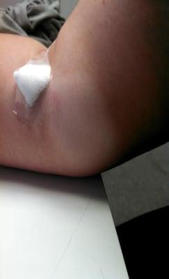 Initial lump, roughly 1 hour after injection