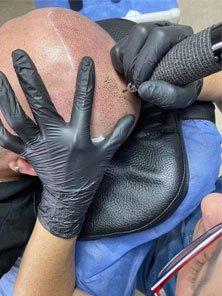 Scalp micropigmentation is a tattoo-like method that imitates hair follicles using specialized pigments on the scalp.