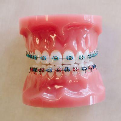 Fun color selection for your braces!