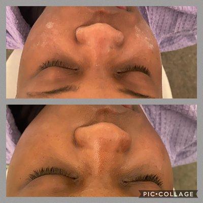 Microdermabrasion