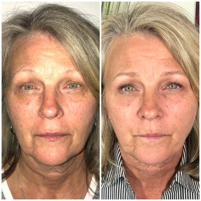 Noninvasive FaceLift RF