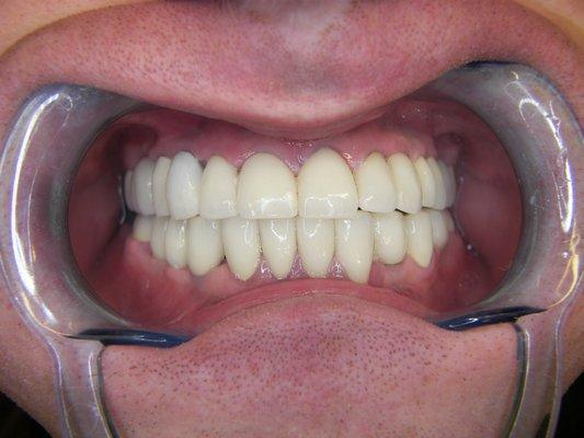 Full mouth, implants, crowns roots all same day