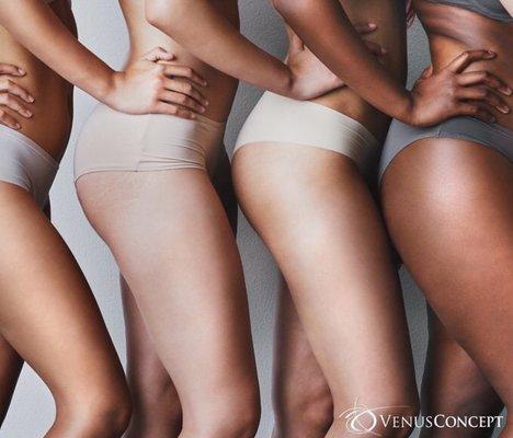 Safe for all skin tones. Keep the curves and lose the fat!