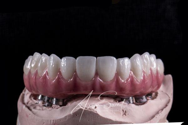 Beautiful set of zirconia teeth supported by all on 6 dental implants for a very sweet patient.