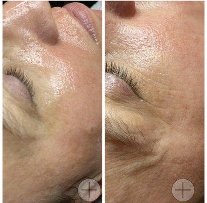 Opti Resurfacing Treatment