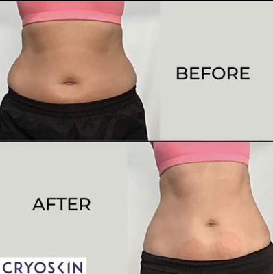 Cryoskin slimming