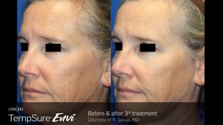 Tempsure helps tighten skin and reduce resting fine line as shown on these before and after pictures