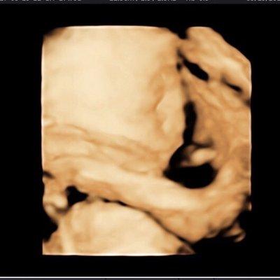 The quality of the 3D Ultrasound pictures I got from "Motherhood Ultrasound" TERRIBLE!!