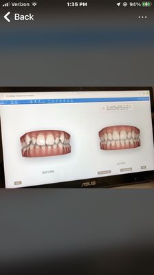 Invisalign