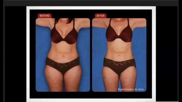 Laser Trim provides scientifically proven and FDA approved laser body contouring with no side effects