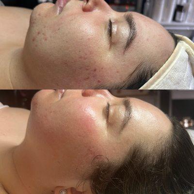 Acne Bootcamp, Before and After