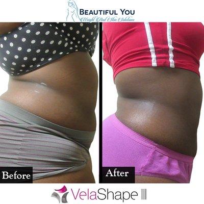 Our VelaShape III Non-Surgical Body Contouring provides amazing results.