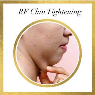 This treatment can also help reduce the appearance of fine lines and wrinkles, tighten the skin, reduce the size of large pores