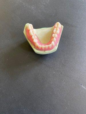 Master Yi's lower implant denture.