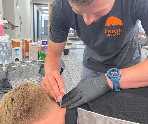 Dry Needling relieves muscle pain and more.