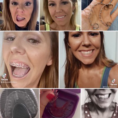 screen shots from my tik tok vids (@amandabrookers) showing my retainers and before/after braces