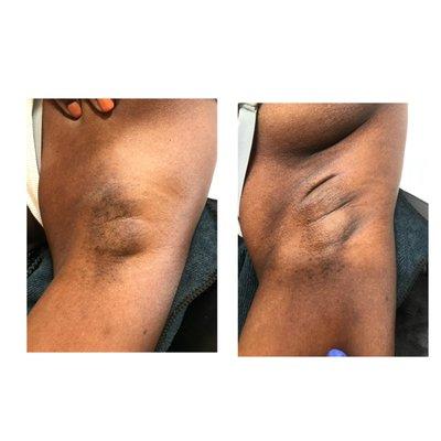 under arm sugaring